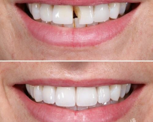 A Solana Beach dental paitent before and after porcelain veneers.