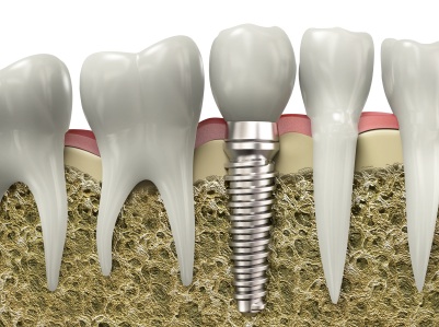A graphic image of a dental implant installed in the jawbone.